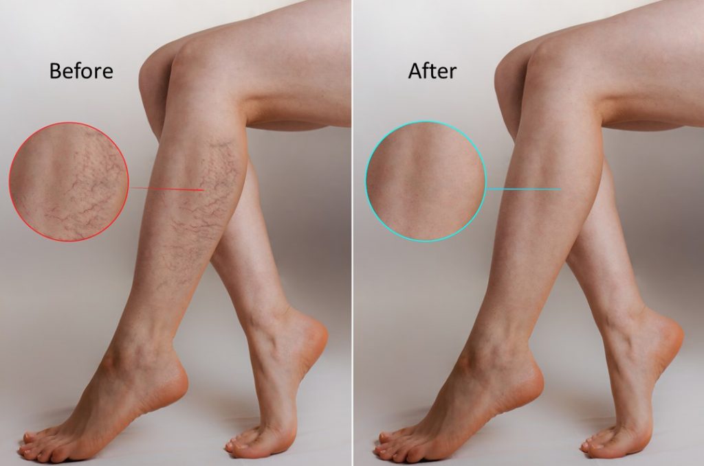 Spider Vein Treatment Options You Need to Know About